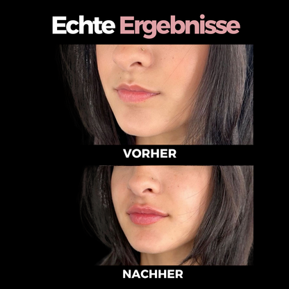 LipLifter™ – Dein Weg zu volleren Lippen